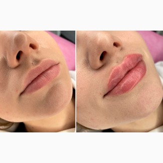 Контурна пластика губ у Києві (Солом#039;янка) - зволоження і збільшення