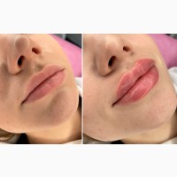 Контурна пластика губ у Києві (Солом#039;янка) - зволоження і збільшення
