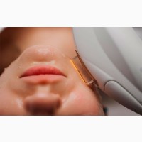 Високоякісний Смас-ліфтинг